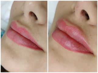 Aumento de labios - Avanti Aesthetic Clinic