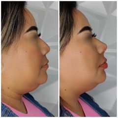 Rinomodelación  - Avanti Aesthetic Clinic