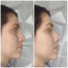 Rinomodelación  - Avanti Aesthetic Clinic