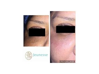 Antes y después de Tratamientos faciales 