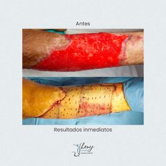 Cirugía reconstructiva - Dr. Jhony Camarero