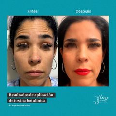 Toxina Botulínica  - Dr. Jhony Camarero