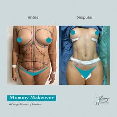 Mommy makeover - Dr. Jhony Camarero