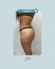 Abdominoplastia - Dr. Jhony Camarero