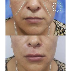 Antes y después de toxina botulínica 