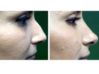 Antes y después de Rinoplastia 