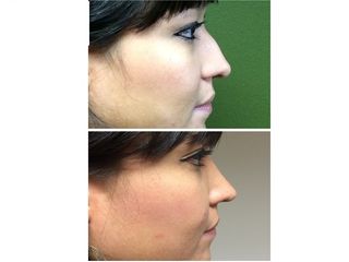 Antes y después de una Rinoplastia