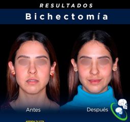 Bichectomia - Dr. Ricardo Guillén