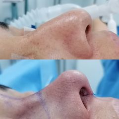 Rinoplastia - Dr. Marcelo Ruiz Siller
