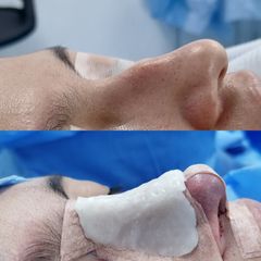 Rinoplastia - Dr. Marcelo Ruiz Siller
