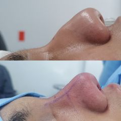 Rinoplastia - Dr. Marcelo Ruiz Siller