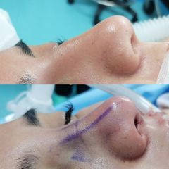 Rinoplastia - Dr. Marcelo Ruiz Siller
