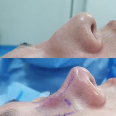 Rinoplastia - Dr. Marcelo Ruiz Siller