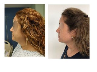 Antes y después de Rinoplastia