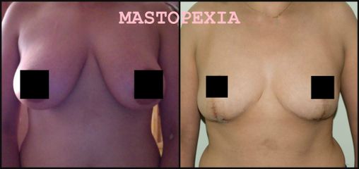 Mastopexia - Dr. Alejandro Cruz Segura