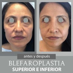 Antes y después de Blefaroplastia