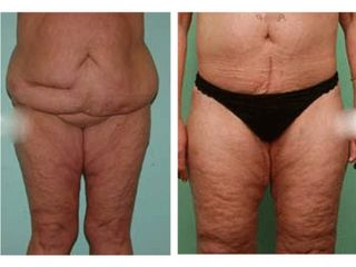 Antes y después Abdominoplastia