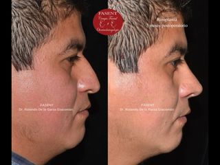 Rinoplastia - Fasent. Dr Rolando de la Garza Giacomán