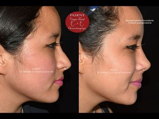 Rinoplastia - Fasent. Dr Rolando de la Garza Giacomán
