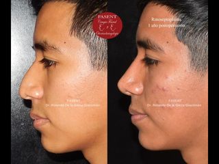 Rinoplastia - Fasent. Dr Rolando de la Garza Giacomán