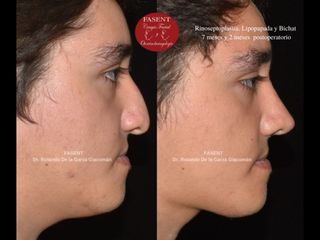 Rinoplastia - Fasent. Dr Rolando de la Garza Giacomán