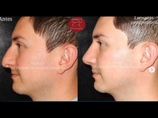 Rinoplastia - Fasent. Dr Rolando de la Garza Giacomán