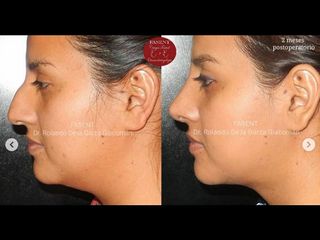 Rinoplastia - Fasent. Dr Rolando de la Garza Giacomán