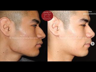 Rinoplastia - Fasent. Dr Rolando de la Garza Giacomán
