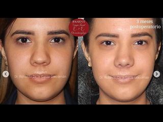Rinoplastia - Fasent. Dr Rolando de la Garza Giacomán
