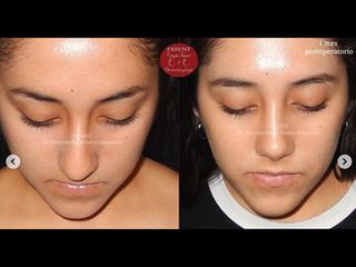 Rinoplastia - Fasent. Dr Rolando de la Garza Giacomán