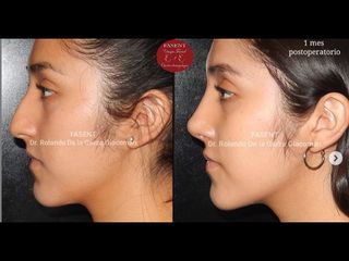 Rinoplastia - Fasent. Dr Rolando de la Garza Giacomán