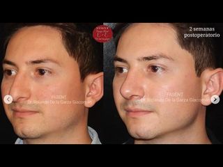 Rinoplastia - Fasent. Dr Rolando de la Garza Giacomán