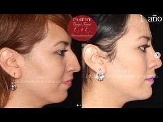 Rinoplastia - Fasent. Dr Rolando de la Garza Giacomán
