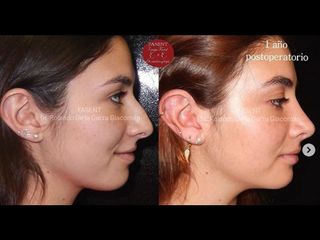 Rinoplastia - Fasent. Dr Rolando de la Garza Giacomán