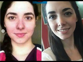 Rinoplastia - Fasent. Dr Rolando de la Garza Giacomán