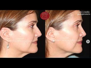 Rinoplastia - Fasent. Dr Rolando de la Garza Giacomán