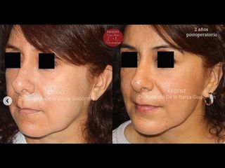 Rinoplastia - Fasent. Dr Rolando de la Garza Giacomán