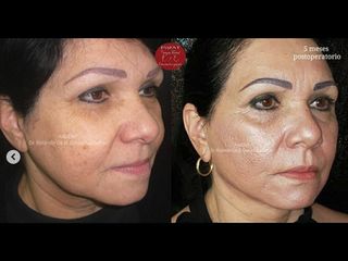 Rinoplastia - Fasent. Dr Rolando de la Garza Giacomán