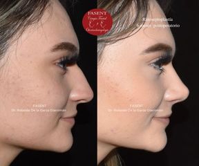Rinoplastia - Fasent. Dr Rolando de la Garza Giacomán