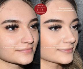 Rinoplastia - Fasent. Dr Rolando de la Garza Giacomán