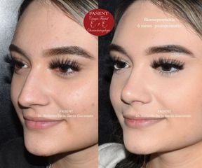 Rinoplastia - Fasent. Dr Rolando de la Garza Giacomán