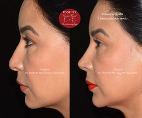 Rinoplastia - Fasent. Dr Rolando de la Garza Giacomán