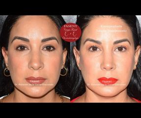 Rinoplastia - Fasent. Dr Rolando de la Garza Giacomán