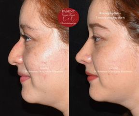 Rinoplastia - Fasent. Dr Rolando de la Garza Giacomán