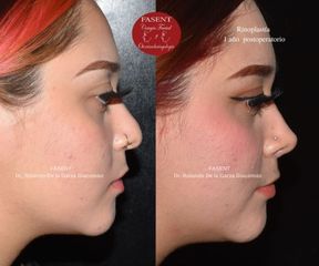 Rinoplastia - Fasent. Dr Rolando de la Garza Giacomán