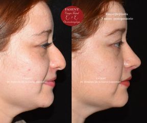 Rinoplastia - Fasent. Dr Rolando de la Garza Giacomán