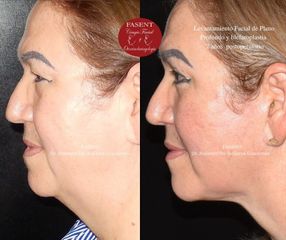 Lifting - Fasent. Dr Rolando de la Garza Giacomán