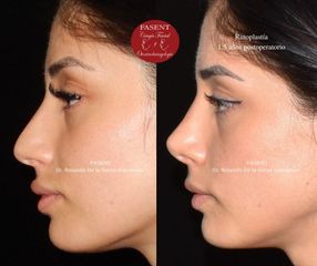 Rinoplastia - Fasent. Dr Rolando de la Garza Giacomán