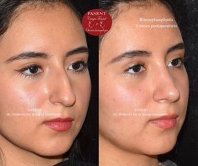 Rinoplastia - Fasent. Dr Rolando de la Garza Giacomán