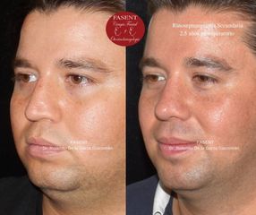 Rinoplastia - Fasent. Dr Rolando de la Garza Giacomán